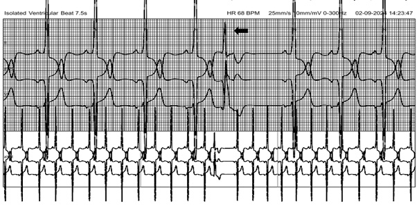 24-hour Holter recording with 3 channels shows a sinus rhythm with a premature ventricular complex followed by a compensatory pause as depicted by the black arrow.