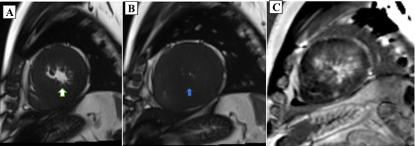 Cardiovascular magnetic imaging demonstrates end diastole and end systole of left ventricular cavity with white and blue arrows in images A and B, respectively, where there is complete obliteration of the left ventricular cavity in the systole. Image C demonstrates late gadolinium enhancement in the left ventricular cavity.
