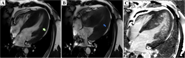 Cardiac magnetic resonance in end diastole and end systole (images A and B, respectively) showing left ventricular mid-cavitary obstruction as seen by the total occlusion of the left ventricular cavity during systole. Image C shows late gadolinium enhancement in the left ventricle in a 4-chamber view.