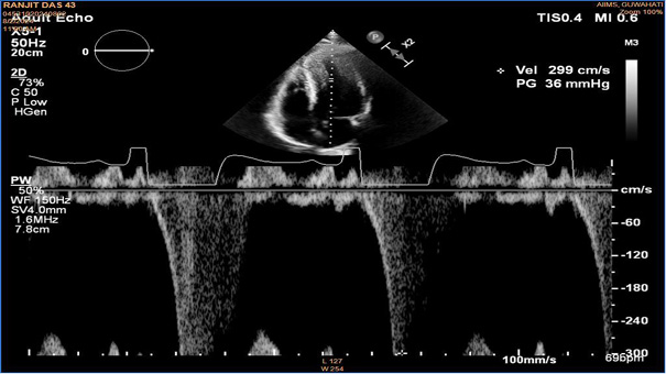 2-dimensional Echocardiographic view in apical four-chamber view with a Pulse wave Doppler through the left ventricular cavity which demonstrates a gradient of 36 mmHg on measurement. The cut-off for the diagnosis of mid cavitary obstruction is 30mm Hg.