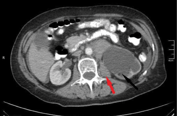 Lymph node enlargement (the red arrow) resulting in hydronephrosis of the left kidney (the black arrow)