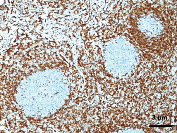 BCL2 staining highlights the presence of BCL2-positive cells, consistent with the diagnosis of an indolent lymphoma, such as NMZL. Original magnification ×10. Scale bar = 3 μm