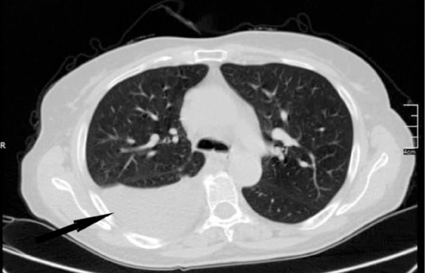 Computed tomography showed a loculated pleural effusion in the right thorax (indicated by arrow) 
