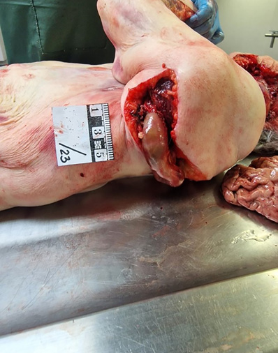 The picture shows the back and upper arm of a person observed from the external view. Partially prolapsed loops of intestine are visible through a tear in the skin and soft tissues at the upper third of the arm and back. The laceration is wide, the edges are not smooth, and the loops of intestine clearly protrude through the wound.