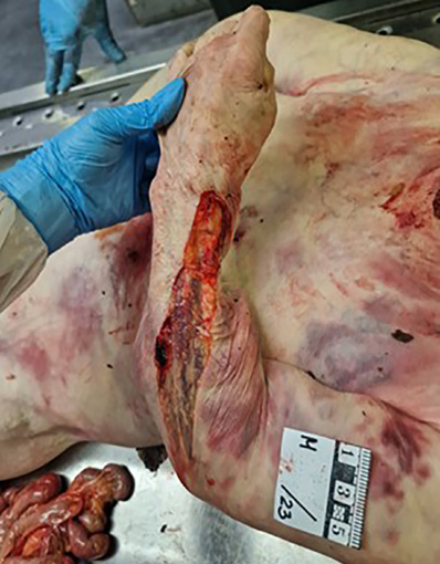 The image shows the left forearm from the outside. The large laceration on the dorsal side of the forearm to the wrist is visible. The bowel loops were trapped in the subcutaneous cavity between the fascia and the subcutaneous fat layer along the dorsal side of the forearm. Several loops of intestine are partially visible protruding through the wrist laceration.