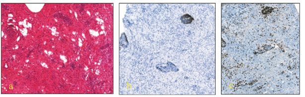 Three histopathological images of brain tissue fragments are displayed from left to right. In the first image (a), the brain fragment is stained with hematoxylin and eosin. The extracellular matrix and cytoplasm appear pink, while the cell nuclei are purplish-blue. In this image, increased glial cellularity, perivascular infiltration with lymphocytes and macrophages are seen. The walls of blood vessels are thickened, edematous, and, in some regions, infiltrated with lymphocytes. The myelin fibers are thinned and, in some areas, degenerated. In the second (b) and third (c) images, immunohistochemistry of the brain tissue fragments is shown. In image (b), stained for CD20, the tissue background appears light blueish, while several cells display brown staining, indicating the presence of the CD20 protein on B lymphocytes. In image (c), stained for CD3, multiple cells also appear brown, representing T lymphocytes positive for the CD3 marker. 
