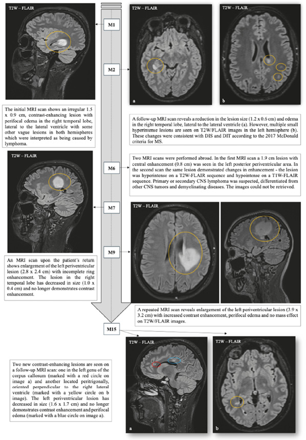 A timeline of changes observed in MRI images from the first symptoms reported to the initial diagnosis. In the center, there is an arrow pointing downwards. Inside the arrow, there are 5 squares containing the letter M followed by a number representing a specific month when an MRI image was obtained. The squares are connected with a dotted line. From top to bottom: month 1, month 2, month 6, month 7, and month 9. The arrow is pointing to a separate square, which represents month 15, indicating the last MRI scan performed on the patient. Each square, representing a specific month, has an arrow pointing to the image of an MRI scan. From the first square, representing month 1, an arrow points to a sagittal T2W-FLAIR brain scan on the left. It shows an irregular 1.5 x 0.9 cm, contrast-enhancing lesion with perifocal edema in the right temporal lobe, lateral to the lateral ventricle with some other vague lesions in both hemispheres which were interpreted as being caused by lymphoma. From the second square, representing month 2, an arrow points to two axial T2W-FLAIR brain images. The first image reveals a reduction in the lesion size (1.2 x 0.6 cm) and edema in the right temporal lobe, lateral to the lateral ventricle. The second image shows multiple small hyperintense lesions in the left hemisphere. These changes were consistent with DIS and DIT according to the 2017 McDonald criteria for MS. From the third square, representing month 6, an arrow points to a text box on the right. Text: Two MRI scans were performed abroad. In the first MRI scan, a 1.9 cm lesion with central enhancement (0.8 cm) was seen in the left posterior periventricular area. In the second scan, the same lesion demonstrated changes in enhancement – the lesion was hyperintense on a T2W-FLAIR sequence and hypointense on a T1W-FLAIR sequence. Primary or secondary CNS lymphoma was suspected, differentiated from other CNS tumors and demyelinating diseases. The images could not be retrieved. From the fourth square, representing month 7, an arrow points to a sagittal T2W-FLAIR brain scan on the left. It shows an enlargement of the left periventricular lesion (2.8 x 2.4 cm) with incomplete ring enhancement. The lesion in the right temporal lobe has decreased in size (1.0 x 0.4 cm), and it no longer demonstrates contrast enhancement. From the fifth square, representing month 9, an arrow points to two T2W-FLAIR MRI images. The first axial and second sagittal T2W-FLAIR images show an enlargement of the left periventricular lesion (3.9 x 3.2 cm) with increased contrast enhancement and perifocal edema and no mass effect. From the last square, representing month 15, two arrows point downwards to two MRI images. The first sagittal T2W-FLAIR image shows a new contrast-enhancing lesion in the left genu of the corpus callosum, while the left periventricular lesion has decreased in size (1.6 x 1.7 cm) and no longer demonstrates contrast enhancement and perifocal edema. The second axial T2W-FLAIR image reveals another contrast-enhancing lesion that is located peritrigonally, oriented perpendicular to the right lateral ventricle.
