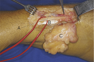 Cheiralgia%20Figure4.png