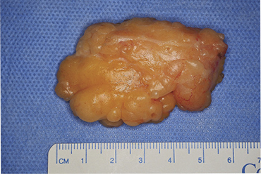 Cheiralgia%20Figure5.JPG