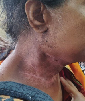 A woman with a scar on her neck.

Description generated by AI