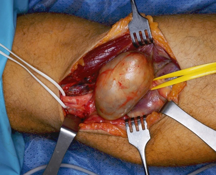 A person's leg with a surgical procedure being performed.

Description generated by AI