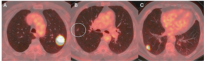 Three images of a lung with red and orange spots.

Description generated by AI