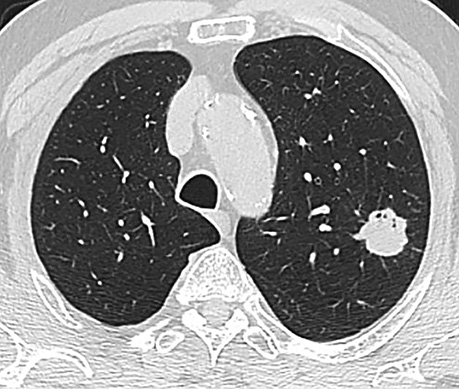 A black and white image of a lung.

Description generated by AI